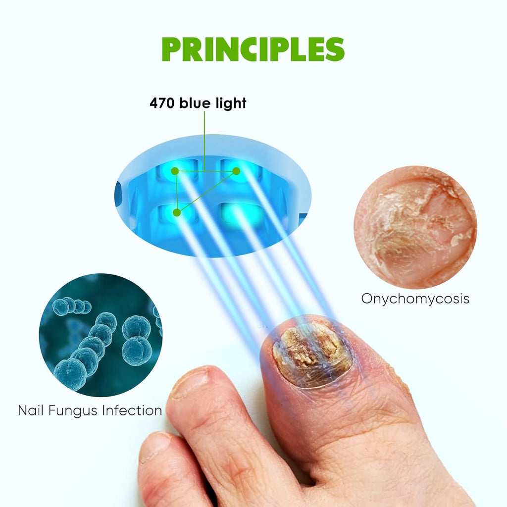 Blue Light Therapy Device for Toenail Fungus E293