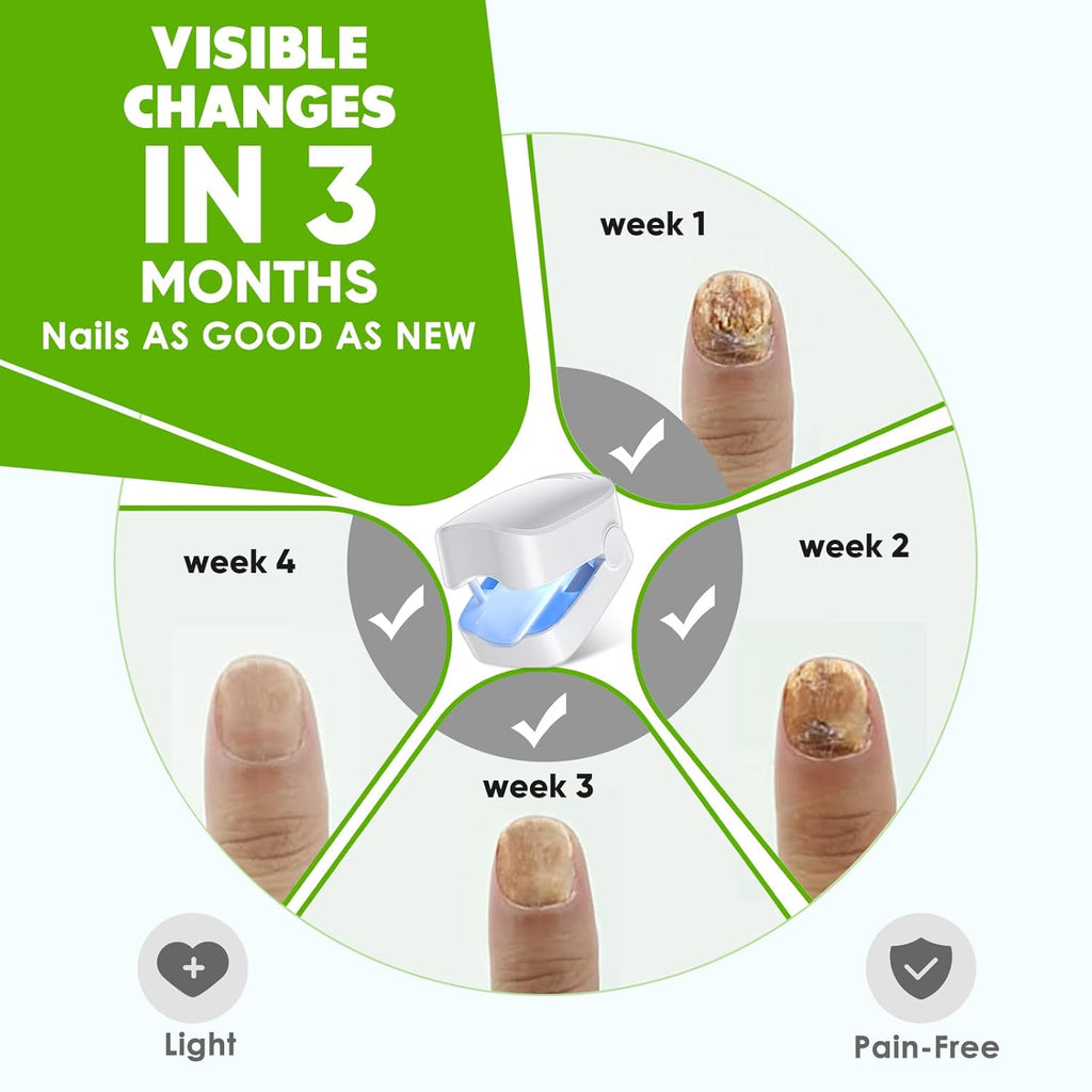 Blue Light Therapy Device for Toenail Fungus E293